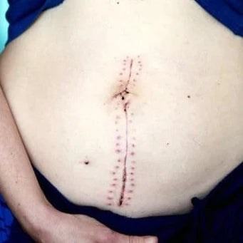 Micro-pigmentation/ Para-medical Tattoo (Cosmetic Tattoo)