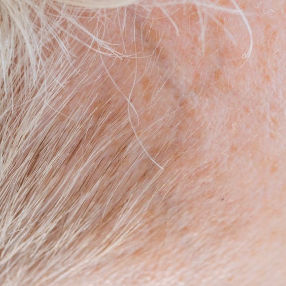 Micro-pigmentation/ Para-medical Tattoo (Cosmetic Tattoo)